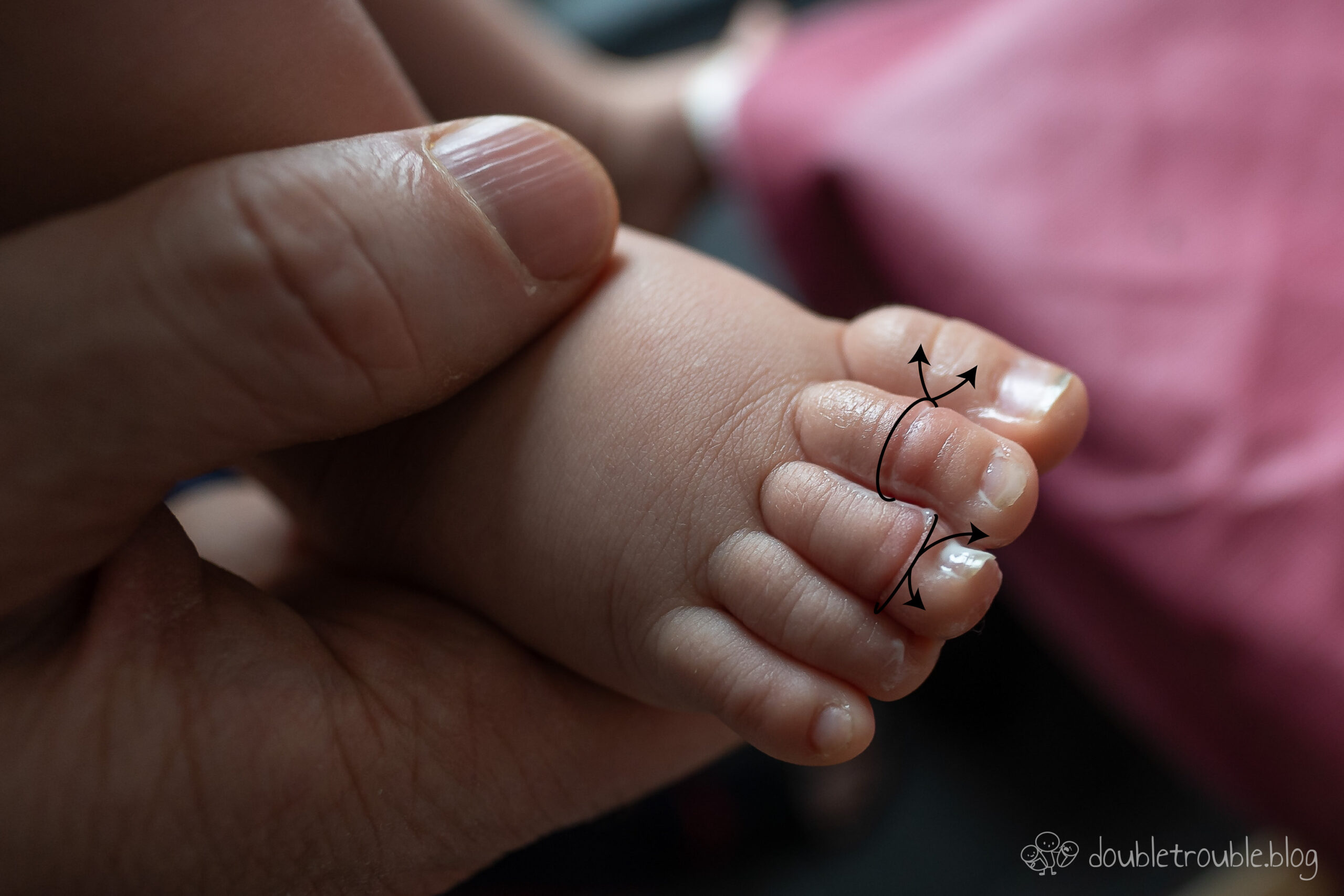 Unser Baby hat das Tourniquet Syndrom